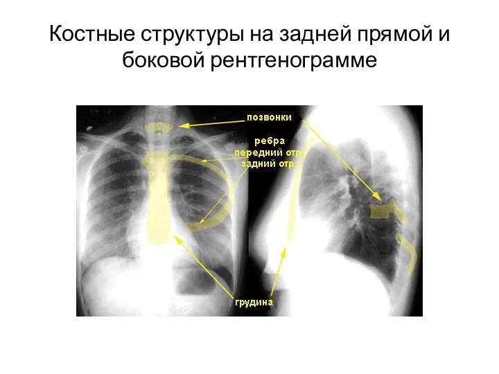 Костные структуры на задней прямой и боковой рентгенограмме