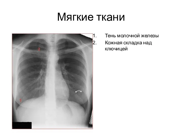 Мягкие ткани Тень молочной железы Кожная складка над ключицей 1 2