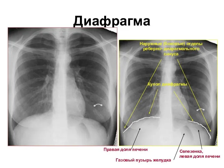 Диафрагма Наружные (боковые) отделы реберно- диарагмального синуса Купол диафрагмы Правая доля печени