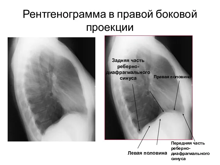 Рентгенограмма в правой боковой проекции Левая половина Правая половина Задняя часть реберно-