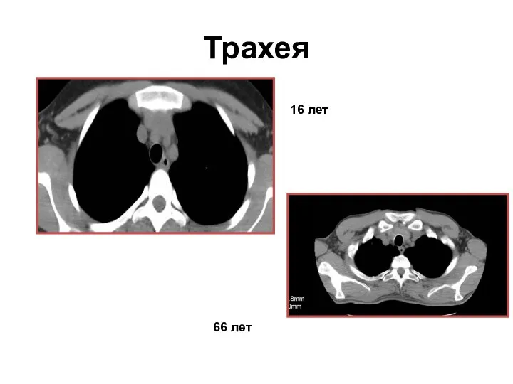 Трахея 16 лет 66 лет