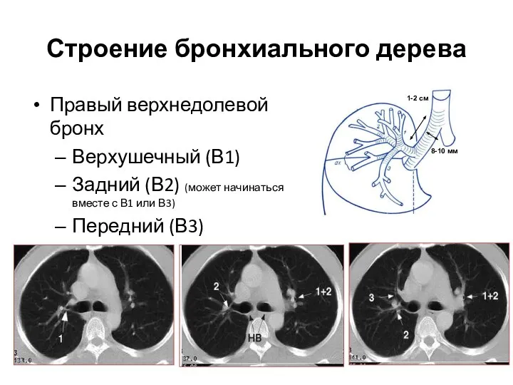 Строение бронхиального дерева Правый верхнедолевой бронх Верхушечный (В1) Задний (В2) (может начинаться