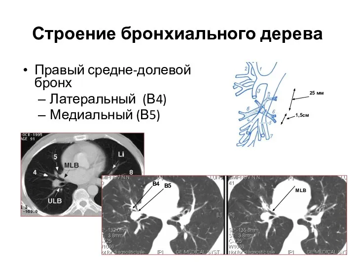Строение бронхиального дерева Правый средне-долевой бронх Латеральный (В4) Медиальный (В5) В5 В4 MLB 1,5см 25 мм