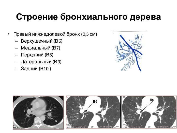 Строение бронхиального дерева Правый нижнедолевой бронх (0,5 см) Верхушечный (В6) Медиальный (В7)