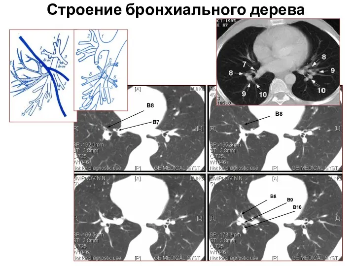 Строение бронхиального дерева В7 В8 В8 В8 В9 В10