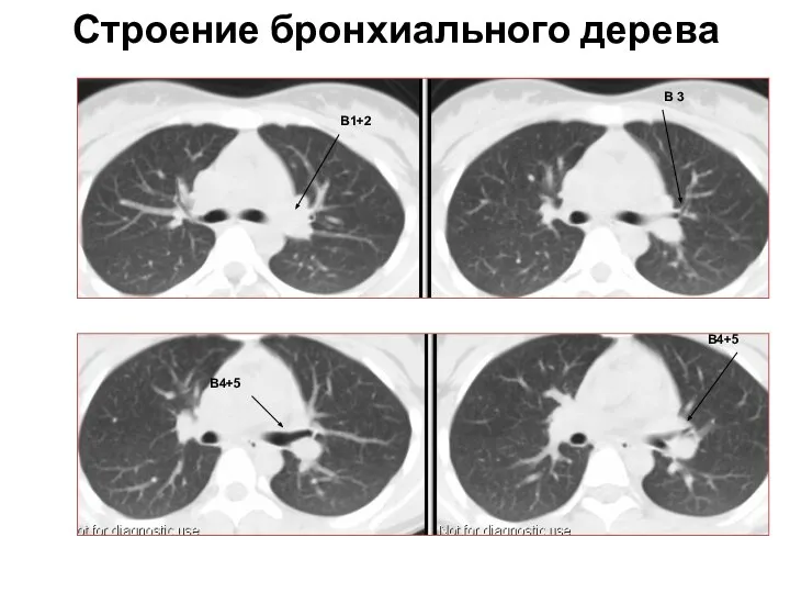 Строение бронхиального дерева В1+2 В4+5 В 3 В4+5