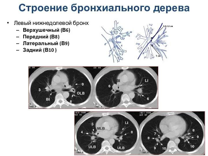 Левый нижнедолевой бронх Верхушечный (В6) Передний (В8) Латеральный (В9) Задний (В10 )