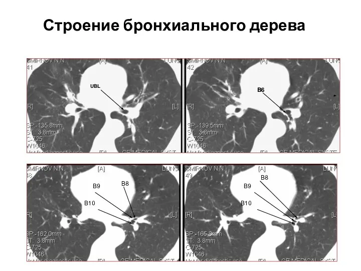 UBL В6 В8 В9 В10 В8 В9 В10 Строение бронхиального дерева