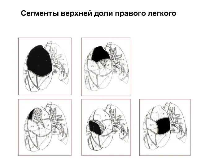 Сегменты верхней доли правого легкого