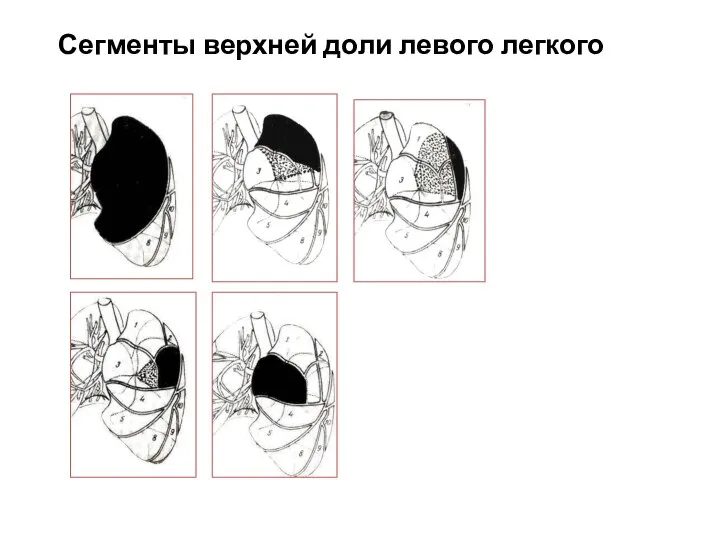 Сегменты верхней доли левого легкого