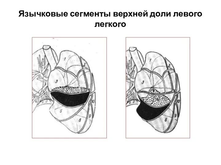 Язычковые сегменты верхней доли левого легкого