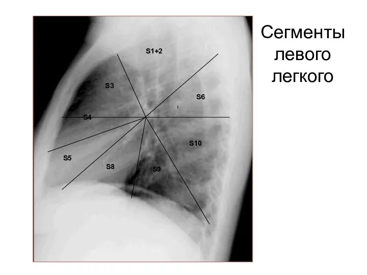 Сегменты левого легкого S1+2 S3 S4 S8 S5 S9 S6 S10