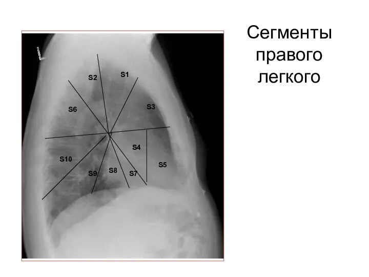 Сегменты правого легкого S4 S5 S7 S8 S9 S10 S6 S2 S1 S3