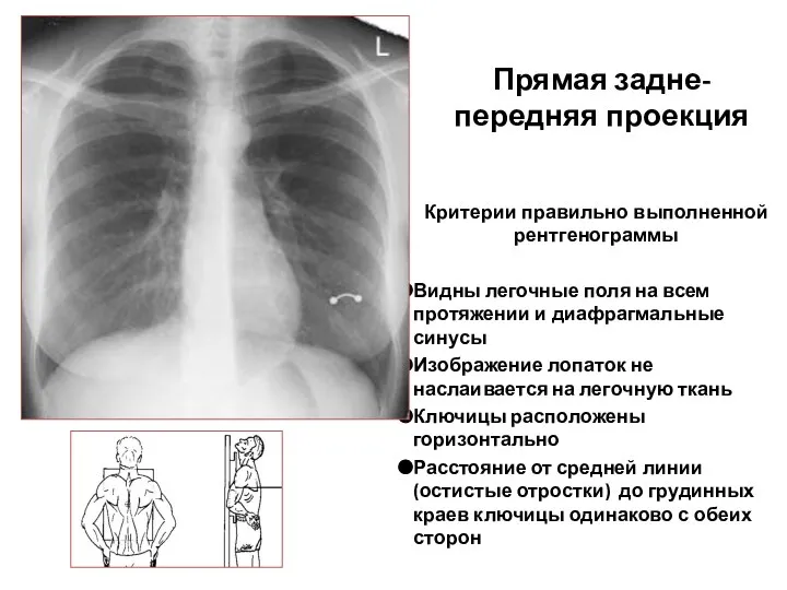 Прямая задне- передняя проекция Критерии правильно выполненной рентгенограммы Видны легочные поля на