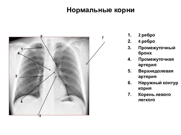 2 ребро 4 ребро Промежуточный бронх Промежуточная артерия Верхнедолевая артерия Наружный контур