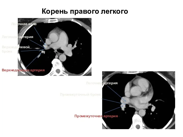 Корень правого легкого Легочная вена Легочная артерия Верхнедолевой бронх Легочная артерия Промежуточный