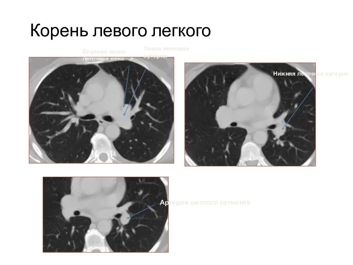 Корень левого легкого Нижняя легочная артерия Верхняя левая легочная вена Левая легочная артерия Артерия шестого сегмента