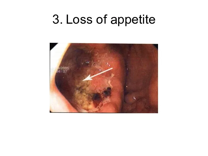 3. Loss of appetite