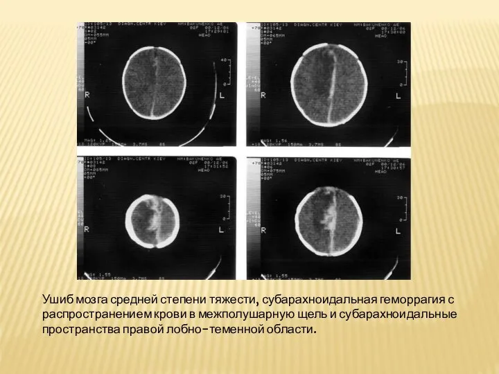 Ушиб мозга средней степени тяжести, субарахноидальная геморрагия с распространением крови в межполушарную