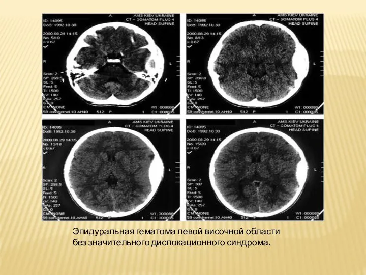 Эпидуральная гематома левой височной области без значительного дислокационного синдрома.