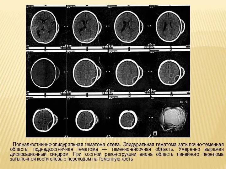 Поднадкостнично-эпидуральная гематома слева. Эпидуральная гематома затылочно-теменная область, поднадкостничная гематома — теменно-височная область.