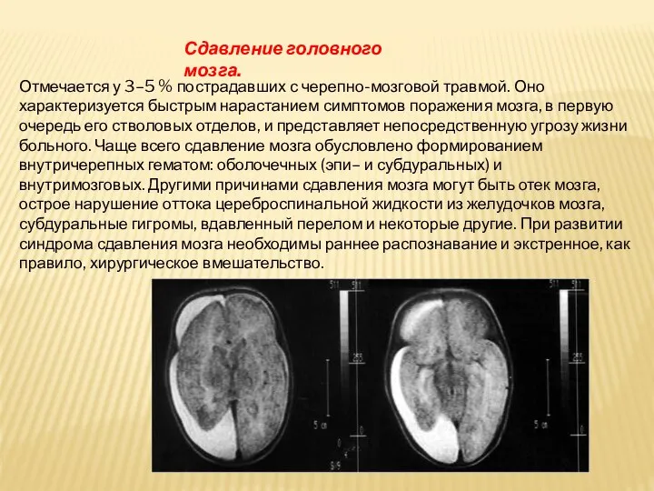 Сдавление головного мозга. Отмечается у 3–5 % пострадавших с черепно-мозговой травмой. Оно