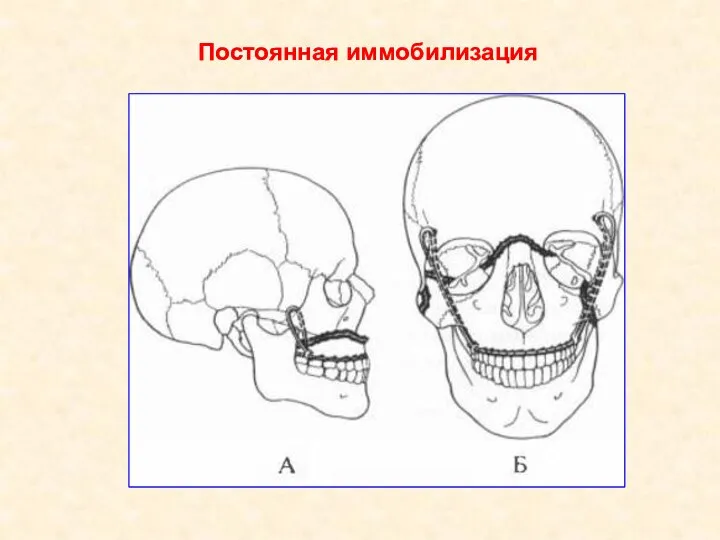 Постоянная иммобилизация