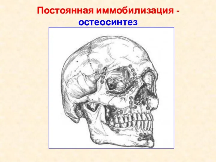 Постоянная иммобилизация - остеосинтез