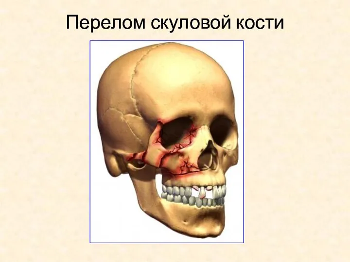 Перелом скуловой кости
