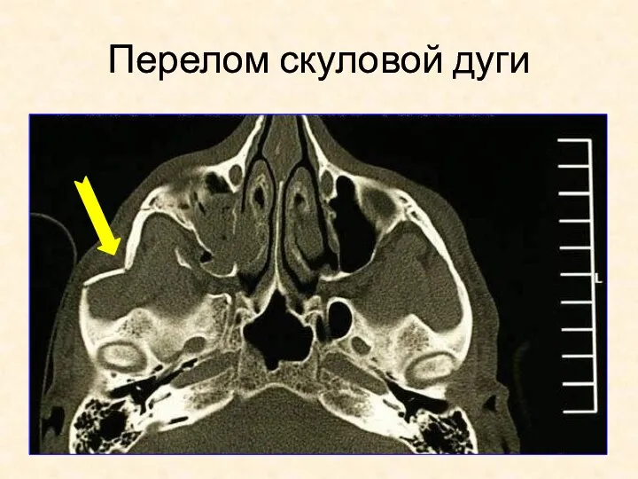 Перелом скуловой дуги