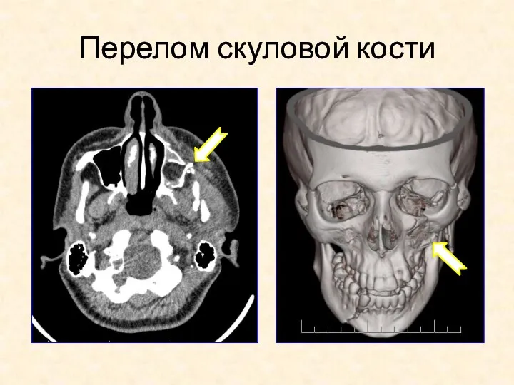 Перелом скуловой кости