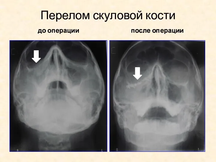 Перелом скуловой кости до операции после операции