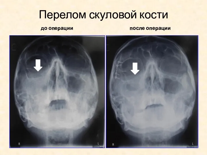 Перелом скуловой кости до операции после операции