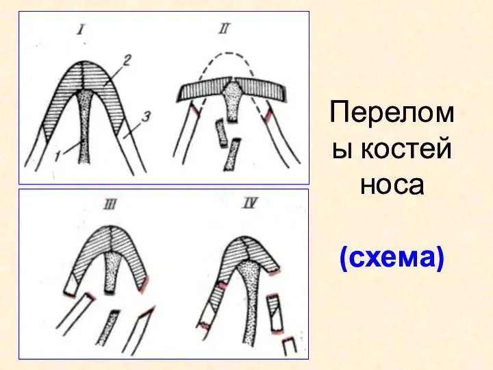 Переломы костей носа (схема)