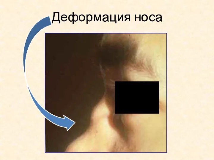 Деформация носа
