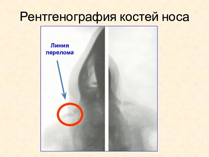 Рентгенография костей носа Линия перелома