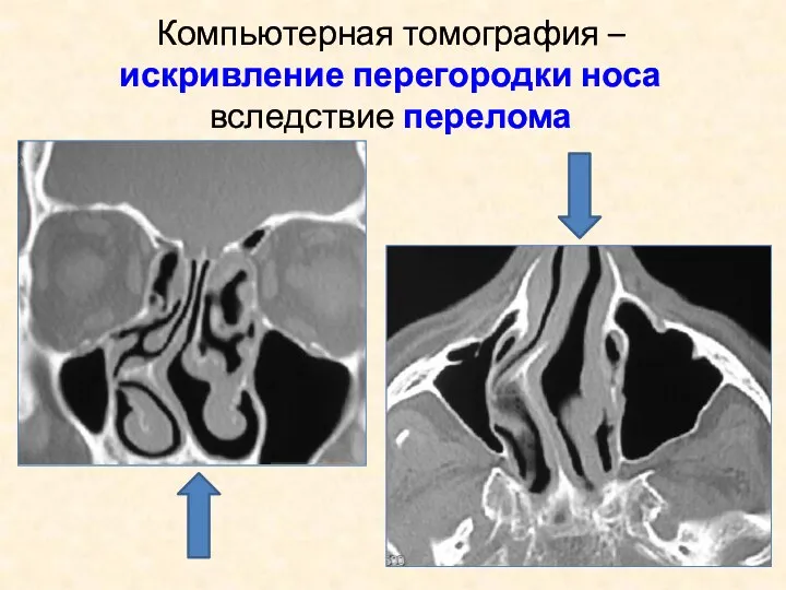 Компьютерная томография – искривление перегородки носа вследствие перелома