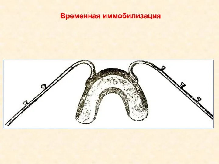 Временная иммобилизация