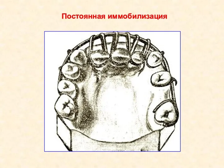 Постоянная иммобилизация