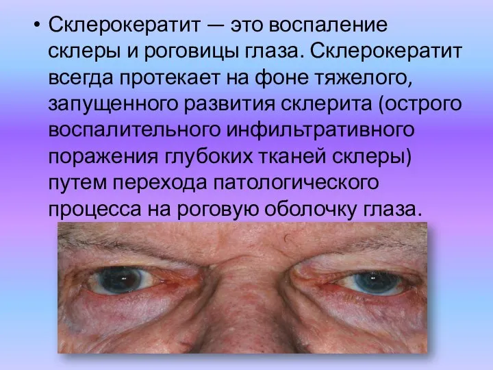 Склерокератит — это воспаление склеры и роговицы глаза. Склерокератит всегда протекает на