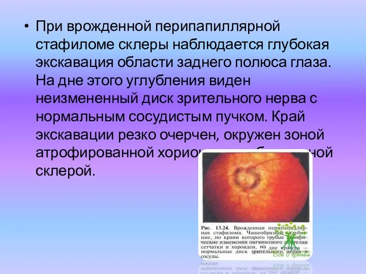 При врожденной перипапиллярной стафиломе склеры наблюдается глубокая экскавация области заднего полюса глаза.