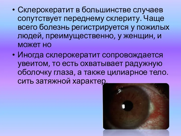 Склерокератит в большинстве случаев сопутствует переднему склериту. Чаще всего болезнь регистрируется у