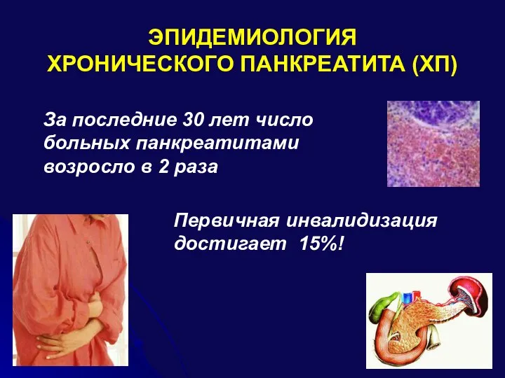 ЭПИДЕМИОЛОГИЯ ХРОНИЧЕСКОГО ПАНКРЕАТИТА (ХП) За последние 30 лет число больных панкреатитами возросло