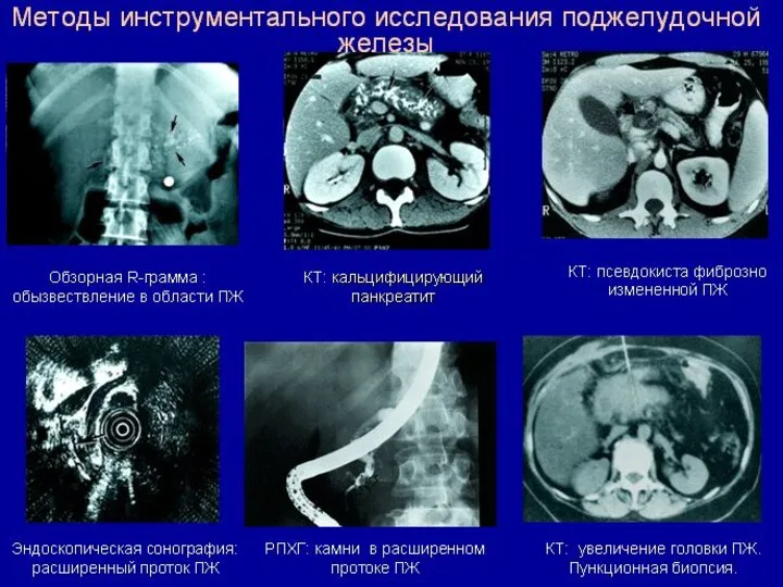 Увеличение ПЖ (чаще тотальное, реже одного из отделов) Подчеркнутость контуров при слабом