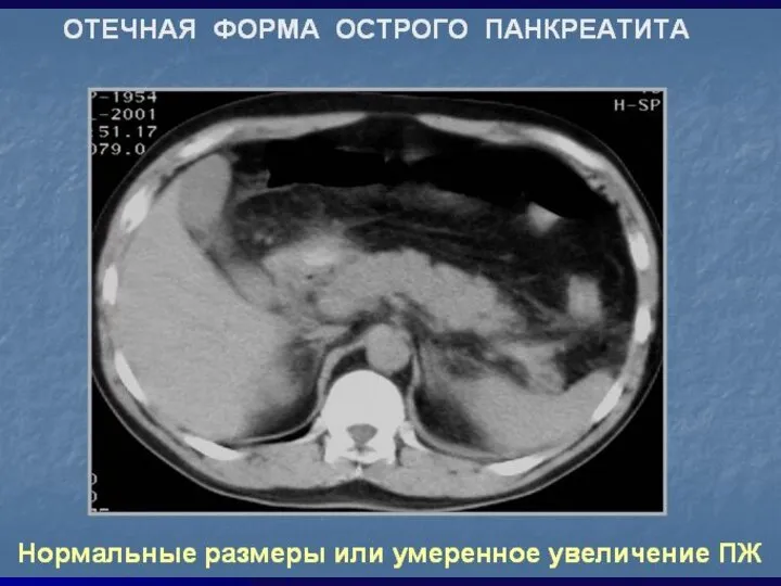 ЛЕЧЕБНОЕ ПИТАНИЕ При ОП и обострении ХРП – голод на 2-4 дня