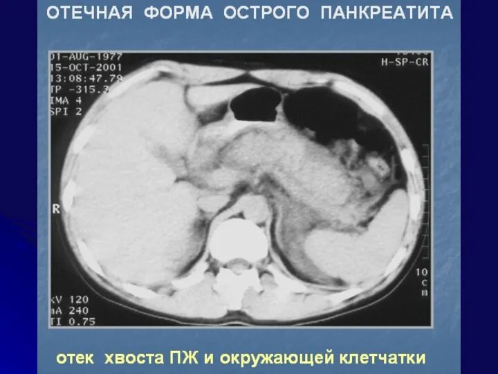 ЛЕЧЕБНОЕ ПИТАНИЕ При ОП и обострении ХРП – голод на 2-4 дня