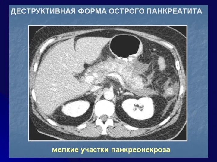 ЛЕЧЕБНОЕ ПИТАНИЕ При ОП и обострении ХРП – голод на 2-4 дня