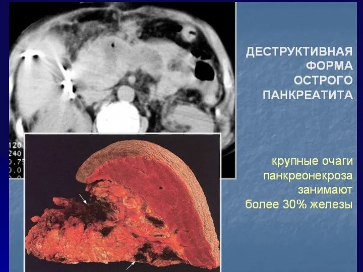 ЛЕЧЕБНОЕ ПИТАНИЕ При ОП и обострении ХРП – голод на 2-4 дня