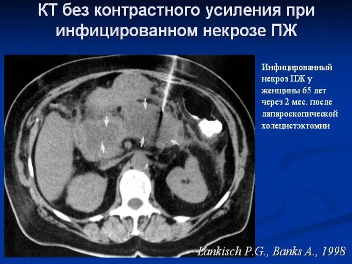 ДИАГНОСТИКА Сдавление портальный и (или) селезеночных вен Свободная жидкость в брюшной полости