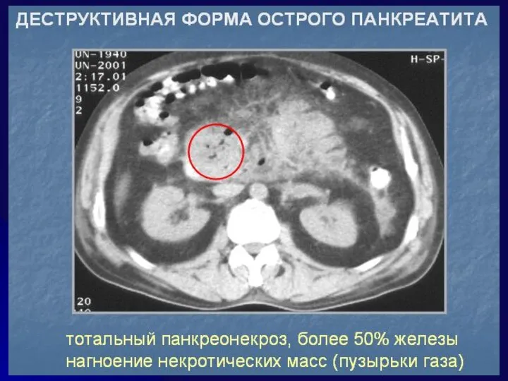 ДИАГНОСТИКА Сдавление портальный и (или) селезеночных вен Свободная жидкость в брюшной полости